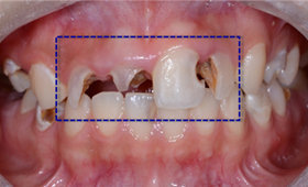 All-ceramic 치료 전