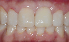 정중이개(벌어진 앞니) 수복 레진 치료 후